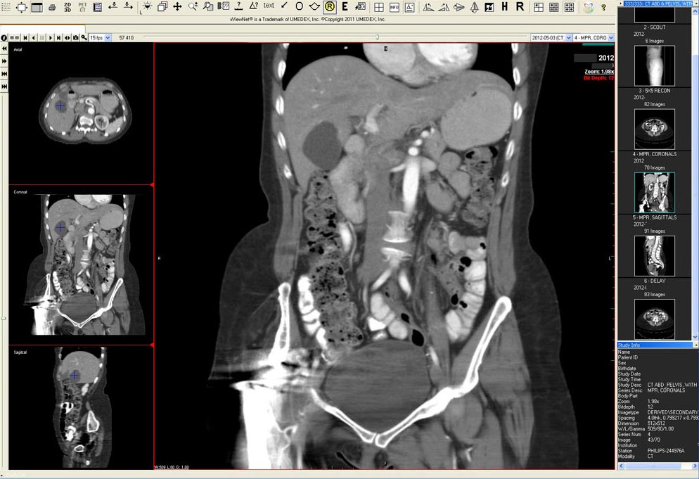 CT scan