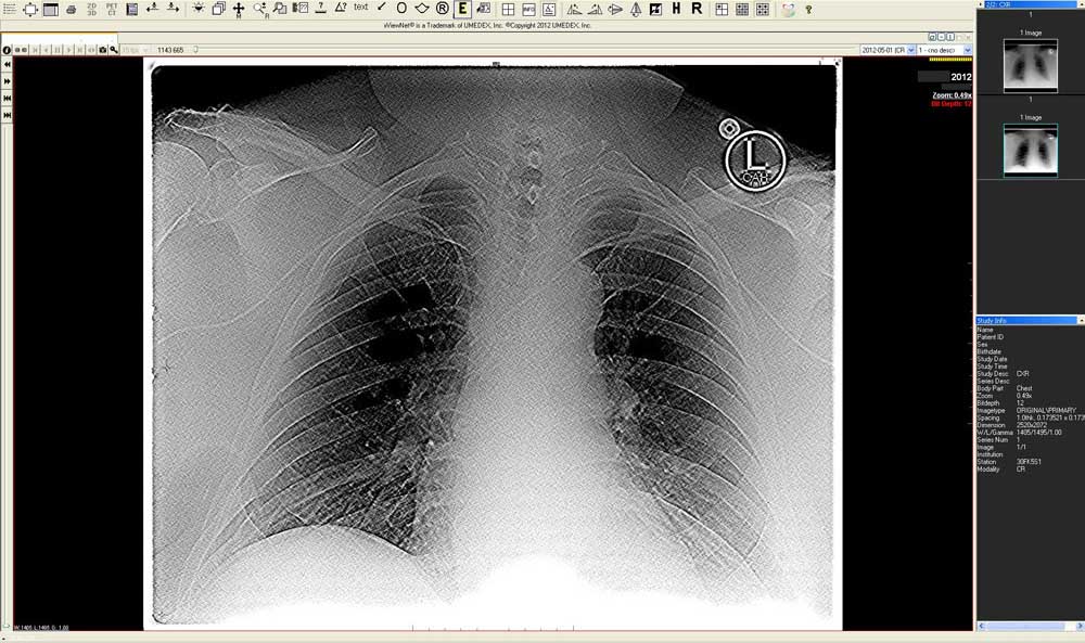PICC line double sharp diagnostic x-ray