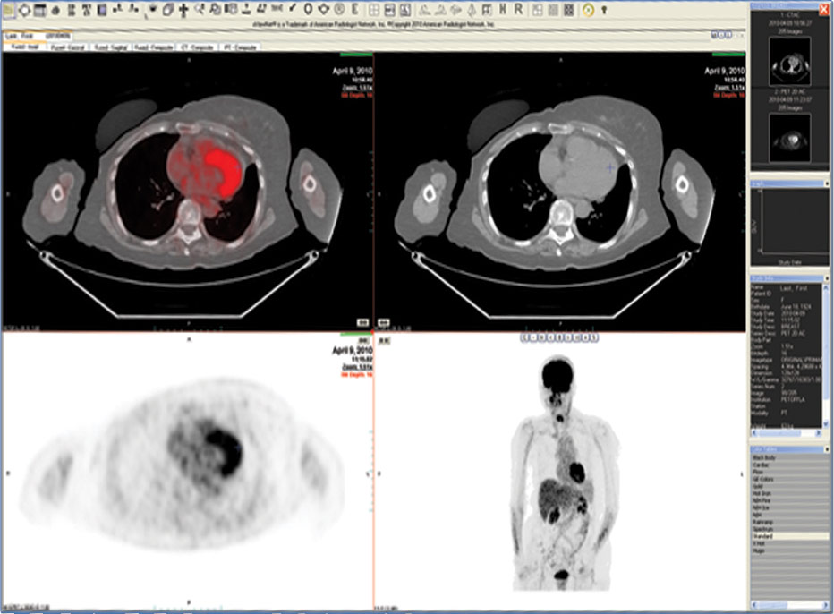 PET and PET/CT