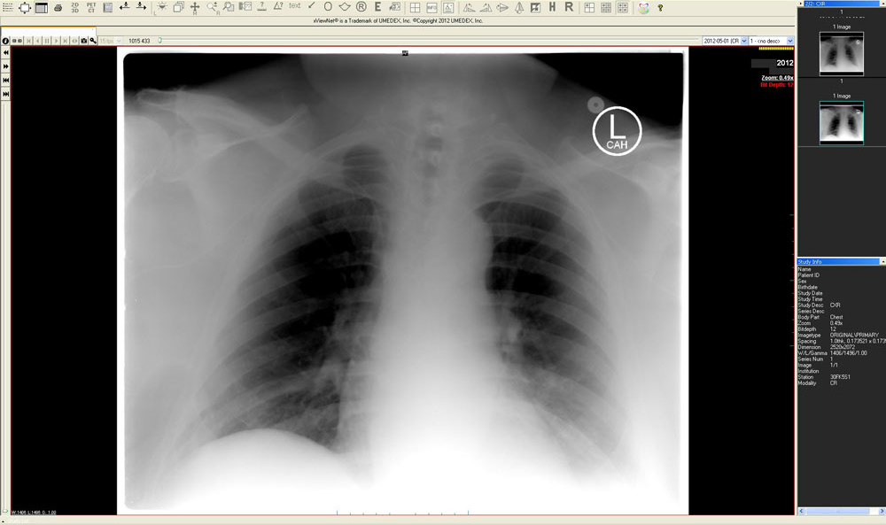 PICC line double diagnostic x-ray